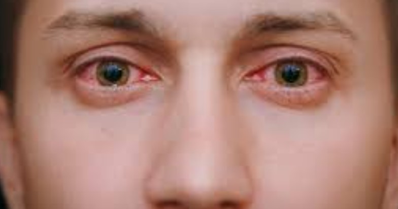 Around 15,000 cases of ‘Eye Flu’ in J-K