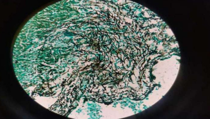 World's first case of white fungus damaging intestine reported at Delhi's Ganga Ram Hospital
