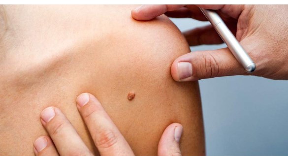 New skin growth, size and colour of moles may be skin cancer: Doctors